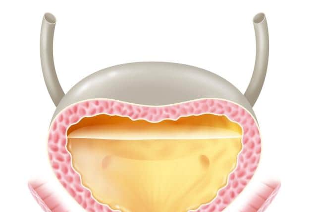 What is bladder cancer?