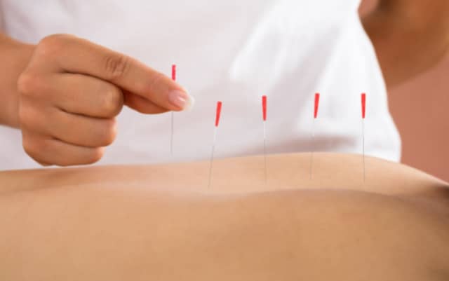Acupuncture that provides relief in Castletroy Town Centre