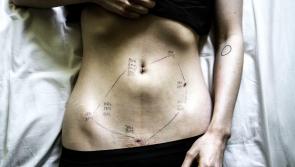 Endometriosis explainer: A debilitating condition often dismissed