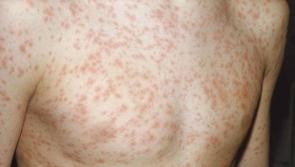 Measles: HSE urges Dublin flight passengers to come forward after third case confirmed in Ireland